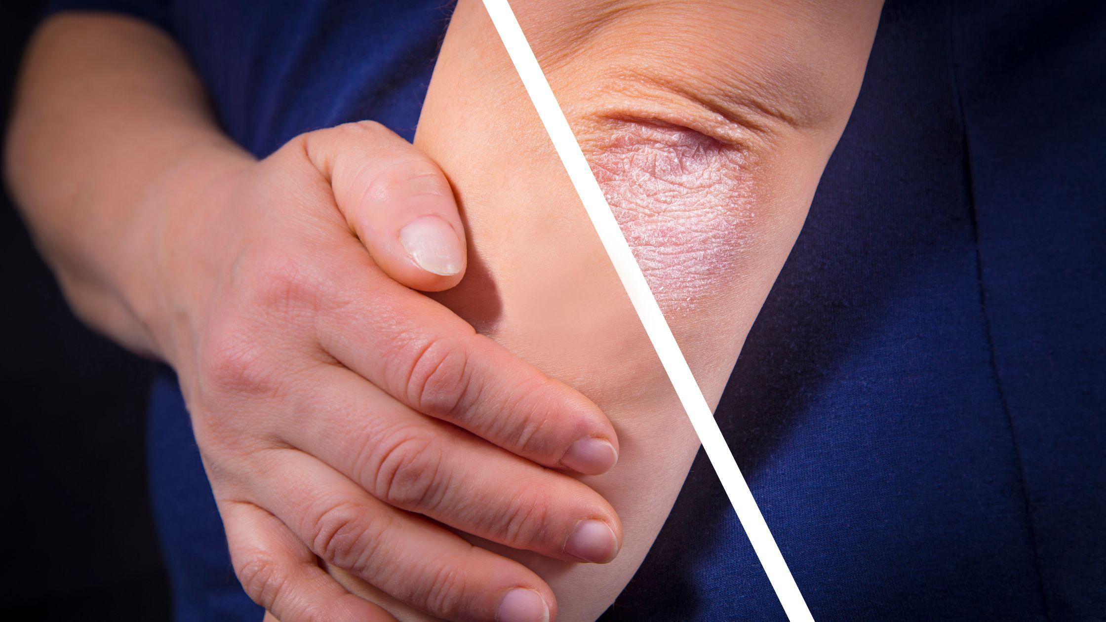 Psoriasis-skin-condition (3).jpg